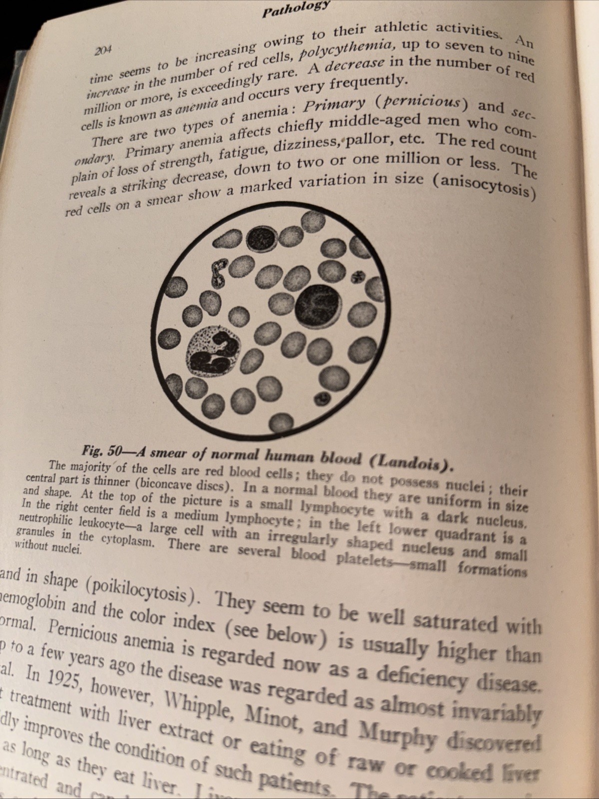Text Book of pathology 1945, 5th Edition, Illustrated